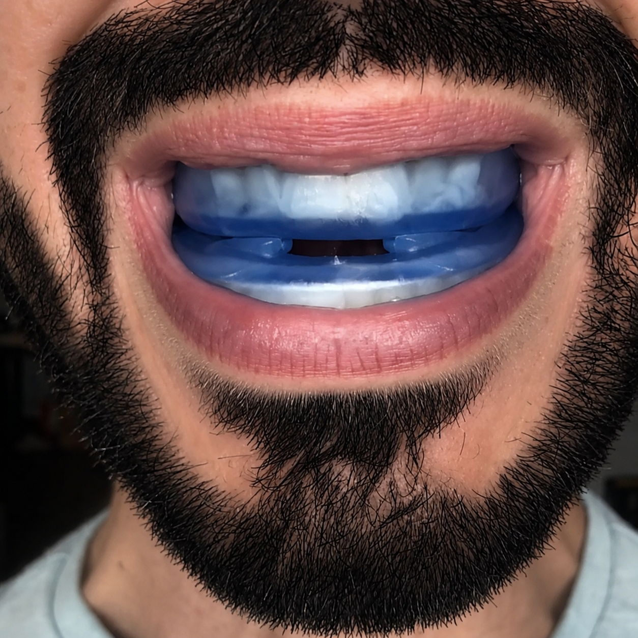 Close-up of mouth wearing the SilentBite anti-snoring mouthpiece